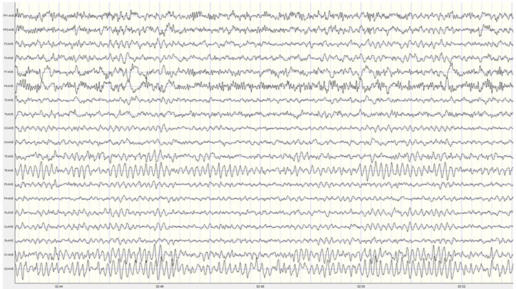 Average reference montage EEG showing 9 Hz activity at T6 electrode